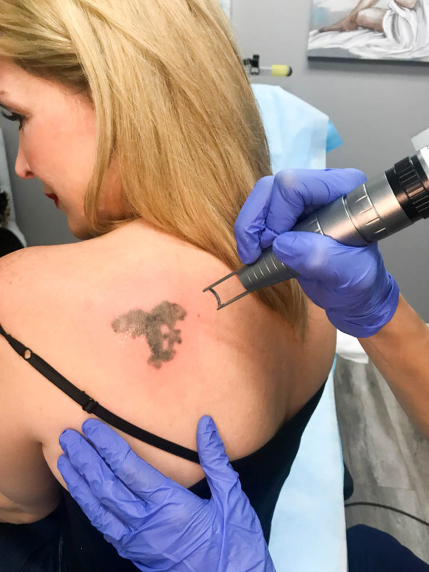 No More Ink: Laser Tattoo Removal featured by popular Los Angeles style blogger, The Hunter Collector